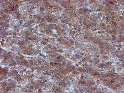 Immunohistochemistry: Iduronate 2-Sulfatase/IDS Antibody (OTI4G2) - Azide and BSA Free [NBP2-70996] - Staining of paraffin-embedded Carcinoma of Human liver tissue using anti-Iduronate 2 sulfatase mouse monoclonal antibody.