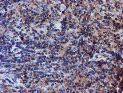 Immunohistochemistry: Iduronate 2-Sulfatase/IDS Antibody (OTI4G2) - Azide and BSA Free [NBP2-70996] - Staining of paraffin-embedded Human lymphoma tissue using anti-Iduronate 2 sulfatase mouse monoclonal antibody.