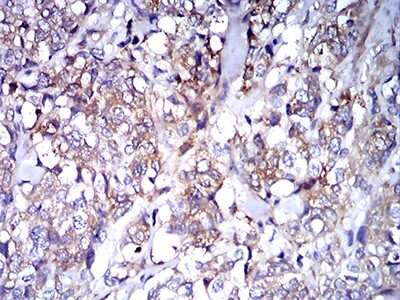 Immunohistochemistry-Paraffin: IgA Antibody (7D5F12) [NBP2-61794] - Analysis of breast cancer tissues using IghA1 mouse mAb with DAB staining.