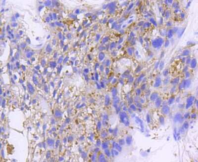 Immunohistochemistry-Paraffin: IkB-beta Antibody (SN0648) [NBP2-67645] - Analysis of paraffin-embedded human breast carcinoma tissue using anti-IKB beta antibody. Counter stained with hematoxylin.