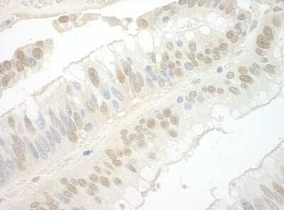 <b>Independent Antibodies Validation and Biological Strategies Validation.</b>Immunohistochemistry-Paraffin: Importin-7 Antibody [NBP1-46168] - Section of human colon carcinoma. Antibody: Affinity purified rabbit antiImportin 7  used at a dilution of 1:1,000 (0.2ug/ml) Detection: DAB