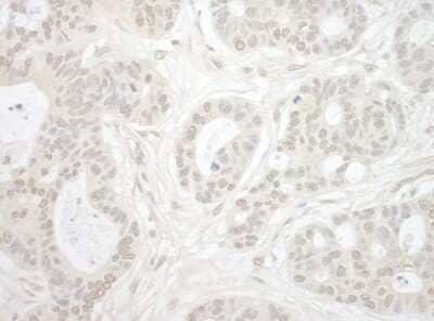 Immunohistochemistry-Paraffin: Importin4 Antibody [NBP1-46165] - Section of human ovarian carcinoma. Antibody: Affinity purified rabbit antiImportin 4  used at a dilution of 1:5,000 (0.2ug/ml) Detection: DAB