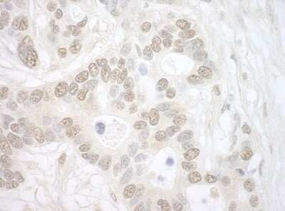 Immunohistochemistry: Importin4 Antibody [NBP1-46166] - Sample: FFPE section of human ovarian carcinoma. Antibody: Affinity purified rabbit anti-Importin 4 used at a dilution of 1:5,000 (0.2ug/ml) Detection: DAB staining using Immunohistochemistry Accessory Kit .