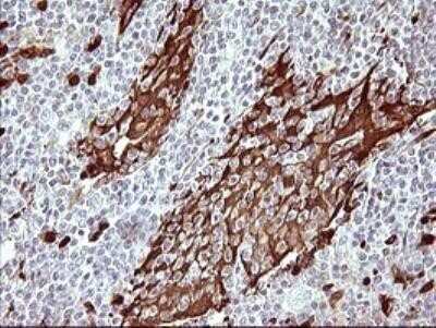 Immunohistochemistry: Indoleamine 2,3-dioxygenase/IDO Antibody (OTI2B5) - Azide and BSA Free [NBP2-71038] - Staining of paraffin-embedded Human lymphoma tissue using anti-IDO1 mouse monoclonal antibody. (Heat-induced epitope retrieval by 10mM citric buffer, pH6.0, 120C for 3min.