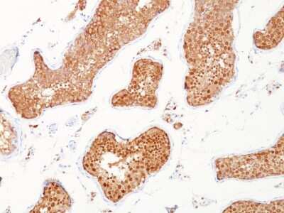 Immunohistochemistry-Paraffin: Inhibin alpha Antibody (INHA/1168) [NBP3-07433] - Formalin-fixed, paraffin-embedded human testicular carcinoma stained with Inhibin alpha Mouse Monoclonal Antibody (INHA/1168).
