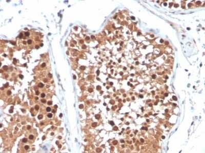 Immunohistochemistry-Paraffin: Inhibin alpha Antibody (R1) - Azide and BSA Free [NBP3-08781] - Formalin-fixed, paraffin-embedded human testicular carcinoma stained with Inhibin alpha Mouse Monoclonal Antibody (R1).
