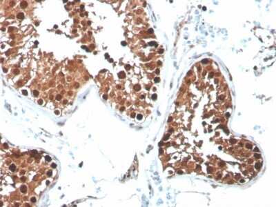 Immunohistochemistry-Paraffin: Inhibin alpha Antibody (R1) - Azide and BSA Free [NBP3-08781] - Formalin-fixed, paraffin-embedded human testicular carcinoma stained with Inhibin alpha Mouse Monoclonal Antibody (R1).