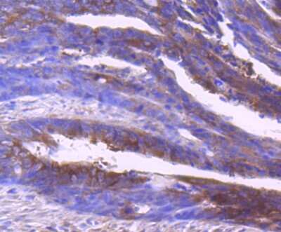 Immunohistochemistry-Paraffin: Insulysin/IDE Antibody (JJ0949) [NBP2-66907] - Analysis of human colon cancer tissue using anti-Insulin degrading enzyme antibody. Counter stained with hematoxylin.