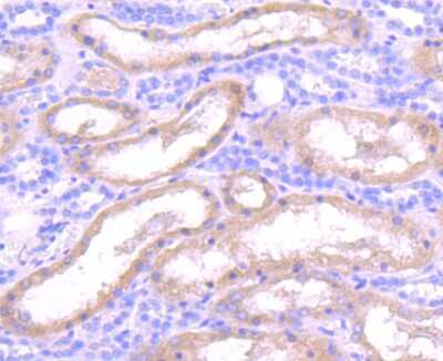 Immunohistochemistry-Paraffin: Insulysin/IDE Antibody (JJ0949) [NBP2-66907] - Analysis of  human liver cancer tissue using anti-Insulin degrading enzyme antibody. Counter stained with hematoxylin.