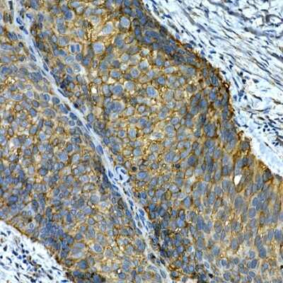 Immunohistochemistry-Paraffin: Integrin alpha 2/CD49b Antibody [NBP3-03851] - Immunohistochemistry of paraffin-embedded human lung cancer using [KO Validated] Integrin alpha 2/CD49b Rabbit pAb (NBP3-03851) at dilution of 1:50 (40x lens). Perform high pressure antigen retrieval with 10 mM citrate buffer pH 6.0 before commencing with IHC staining protocol.