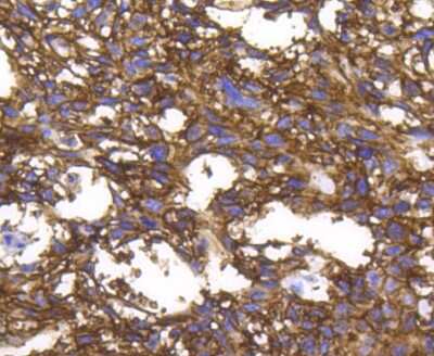 Immunohistochemistry-Paraffin: Integrin alpha 2/CD49b Antibody (SN0752) [NBP2-67691] - Analysis of paraffin-embedded human breast carcinoma tissue using anti-ITGA2 antibody. Counter stained with hematoxylin.