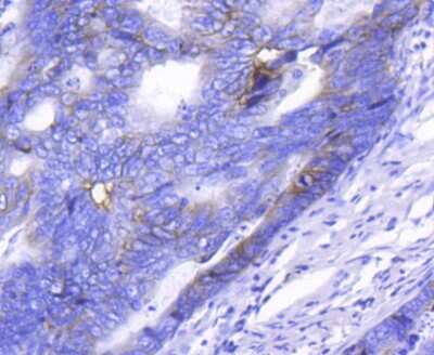 Immunohistochemistry-Paraffin: Integrin alpha 2/CD49b Antibody (SN0752) [NBP2-67691] - Analysis of paraffin-embedded human colon cancer tissue using anti-ITGA2 antibody. Counter stained with hematoxylin.