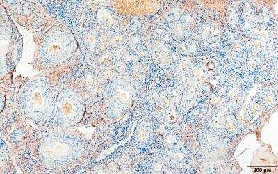 Immunohistochemistry-Paraffin: Integrin alpha 4/CD49d Antibody (PS/2) [NBP1-26661] - FFPE human ovarian carcinoma. Antibody at 1:10. HIER antigen retrieval at pH 6. HRP/DAB detetion. IHC-P  image submitted by a verified customer review.