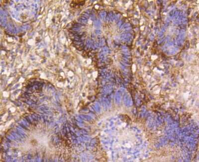 Immunohistochemistry-Paraffin: Integrin beta 1/CD29 Antibody (SA40-08) [NBP2-67291] - Analysis of paraffin-embedded human colon cancer tissue using anti-Integrin beta 1 antibody. Counter stained with hematoxylin.