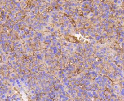 Immunohistochemistry-Paraffin: Integrin beta 1/CD29 Antibody (SA40-08) [NBP2-67291] - Analysis of paraffin-embedded human liver cancer tissue using anti-Integrin beta 1 antibody. Counter stained with hematoxylin.