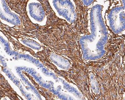 Immunohistochemistry-Paraffin: Integrin beta 1/CD29 Antibody (SA40-08) [NBP2-67291] - Immunohistochemical analysis of paraffin-embedded human colon carcinoma tissue using anti-Integrin beta 1/CD29 antibody. The section was pre-treated using heat mediated antigen retrieval with Tris-EDTA buffer (pH 8.0-8.4) for 20 minutes. The tissues were