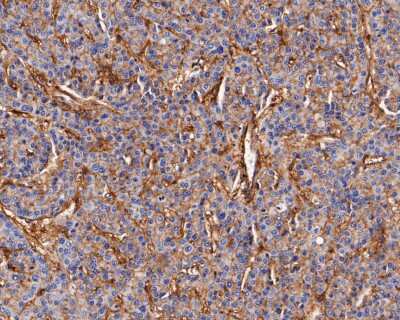Immunohistochemistry-Paraffin: Integrin beta 1/CD29 Antibody (SA40-08) [NBP2-67291] - Immunohistochemical analysis of paraffin-embedded human liver carcinoma tissue using anti-Integrin beta 1/CD29 antibody. The section was pre-treated using heat mediated antigen retrieval with Tris-EDTA buffer (pH 8.0-8.4) for 20 minutes. The tissues were