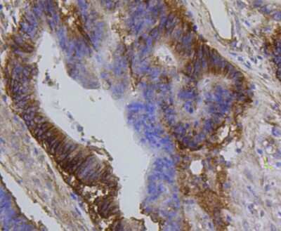 Immunohistochemistry-Paraffin: Integrin beta 1/CD29 Antibody (SR30-03) [NBP2-67312] - Analysis of paraffin-embedded human colon cancer tissue using anti-Integrin beta-1 antibody. Counter stained with hematoxylin.