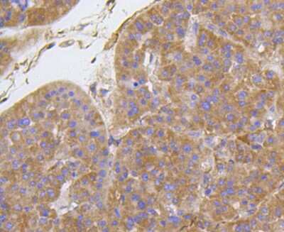 Immunohistochemistry-Paraffin: Integrin beta 1/CD29 Antibody (SR30-03) [NBP2-67312] - Analysis of paraffin-embedded human liver cancer tissue using anti-Integrin beta-1 antibody. Counter stained with hematoxylin.