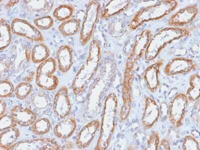 Immunohistochemistry-Paraffin: Integrin beta 3/CD61 Antibody (ITGB3/2166R) - Azide and BSA Free [NBP3-08291] - Formalin-fixed, paraffin-embedded human Renal Cell Carcinoma stained with Integrin beta 3/CD61 Rabbit Recombinant Monoclonal Antibody (ITGB3/2166R).