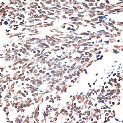 Immunohistochemistry-Paraffin: Intron-Binding Protein Of 160 KDa Antibody [NBP3-03714] - Paraffin-embedded human lung cancer using Intron-Binding Protein Of 160 KDa antibody at dilution of 1:100 (40x lens).