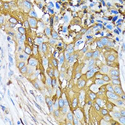 Immunohistochemistry-Paraffin: Involucrin Antibody (8H7B3) [NBP3-15461] - Human lung squamous carcinoma tissue using Involucrin Rabbit mAb (NBP3-15461) at dilution of 1:100 (40x lens).Perform microwave antigen retrieval with 10 mM Tris/EDTA buffer pH 9.0 before commencing with IHC staining protocol.