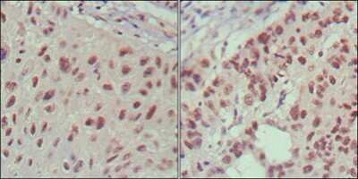 Immunohistochemistry-Paraffin: Islet-1 Antibody (1H9) [NBP1-47537] - Analysis of human lung cancer (left) and cervical carcinoma (right), showing nuclear localization using ISL1 mouse mAb with DAB staining.