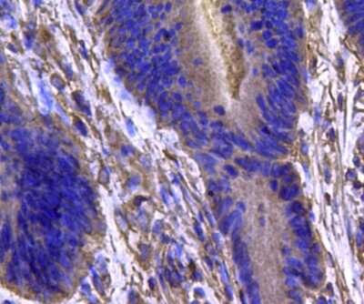 Immunohistochemistry-Paraffin: Isocitrate Dehydrogenase 1/IDH1 Antibody (A11-B4) [NBP2-66911] - Analysis of paraffin-embedded human colon carcinoma tissue using anti-IDH1 antibody. Counter stained with hematoxylin.