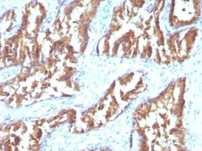 Immunohistochemistry-Paraffin: Isocitrate Dehydrogenase 1/IDH1 Antibody (IDH1/1152) - Azide and BSA Free [NBP2-47744] - Human Prostate Carcinoma stained with IDH1 Monoclonal Antibody (IDH1/1152).