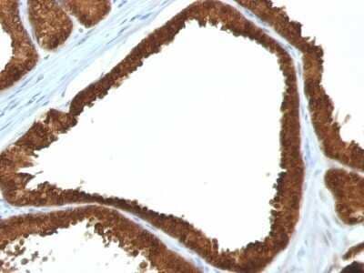 Immunohistochemistry-Paraffin: Isocitrate Dehydrogenase 1/IDH1 Antibody (IDH1/1152) - Azide and BSA Free [NBP2-47744] - Human Colon Carcinoma stained with IDH1 Monoclonal Antibody (IDH1/1152).