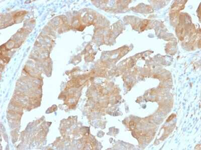 Immunohistochemistry-Paraffin: Isocitrate Dehydrogenase 1/IDH1 Antibody (IDH1/1152) - Azide and BSA Free [NBP2-47744] - Formalin-fixed, paraffin-embedded human Colon Carcinoma stained with Isocitrate Dehydrogenase 1/IDH1 Mouse Monoclonal Antibody (Isocitrate Dehydrogenase 1/IDH1/1152).