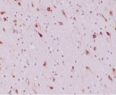 Immunohistochemistry-Paraffin: Isocitrate Dehydrogenase 1/IDH1 Antibody (IDH1/6806R) [NBP3-13943] - FFPE human glioblastoma with IDH1-R132H mutation stained with Isocitrate Dehydrogenase 1/IDH1 antibody (IDH1/6806R). HIER: Tris/EDTA, pH9.0, 45min. HRP-polymer, 30min. DAB, 5min.
