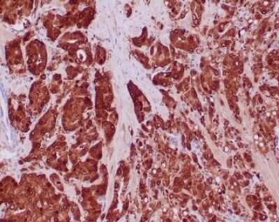 Immunohistochemistry-Paraffin: Isocitrate Dehydrogenase 1/IDH1 Antibody (IDH1/6806R) [NBP3-13943] - FFPE prostate carcinoma with IDH1-R132H mutation stained with Isocitrate Dehydrogenase 1/IDH1 antibody (IDH1/6806R).