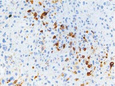 Immunohistochemistry-Paraffin: Isocitrate Dehydrogenase 1/IDH1 Antibody (IHC132) [NBP2-75983] - Isocitrate Dehydrogenase 1/IDH1 (IHC132) in astrocytoma.