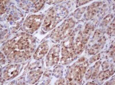 Immunohistochemistry: Isocitrate Dehydrogenase 1/IDH1 Antibody (OTI1D1) - Azide and BSA Free [NBP2-70990] - Analysis of Carcinoma of Human thyroid tissue.