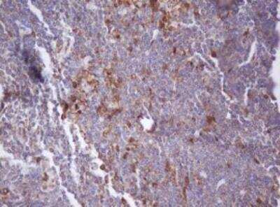 Immunohistochemistry-Paraffin: Isocitrate Dehydrogenase 1/IDH1 Antibody (OTI3G9) [NBP2-46018] - Immunohistochemical staining of paraffin-embedded human lymphoma tissue using anti-IDH1 mouse monoclonal antibody. Heat-induced epitope retrieval by 10 mM citric buffer, pH 6.0, 100C for 10 min.