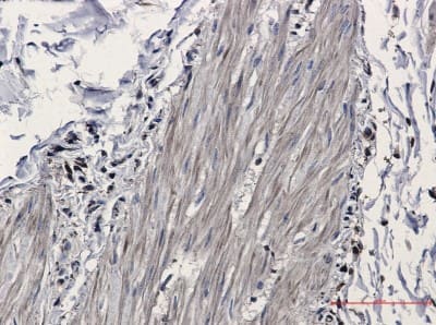 Immunohistochemistry-Paraffin: Isocitrate Dehydrogenase 1/IDH1 Antibody (S05-2G5) [NBP3-19494] - Immunohistochemistry of Isocitrate dehydrogenase in paraffin-embedded Human Cholangiocarcinoma using NBP3-19494 at dilution 1/20
