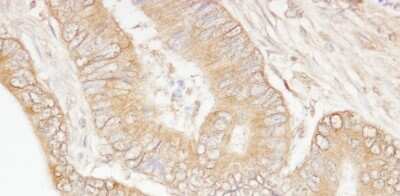 Immunohistochemistry: Isopeptidase T/USP5 Antibody [NB100-77286] - Sample: FFPE section of human colon carcinoma. Antibody: Affinity purified rabbit anti- USP5/IsoT used at a dilution of 1:1,000 (1ug/ml). Detection: DAB