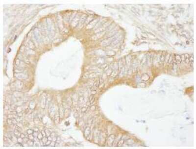 Immunohistochemistry-Paraffin: Isopeptidase T/USP5 Antibody [NB100-77286] - FFPE section of human colon carcinoma.  Affinity purified rabbit anti-USP5 used at a dilution of 1:100. Detection: DAB staining using Immunohistochemistry Accessory Kit.