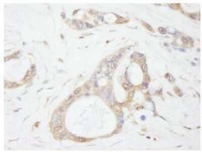 Immunohistochemistry-Paraffin: Isopeptidase T/USP5 Antibody [NB100-77286] - FFPE section of human ovarian carcinoma. Affinity purified rabbit anti-USP5used at a dilution of 1:500. Detection: DAB staining using Immunohistochemistry Accessory Kit