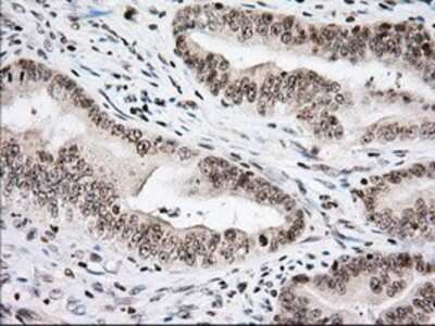 Immunohistochemistry: Isopeptidase T/USP5 Antibody (OTI2E3) - Azide and BSA Free [NBP2-71355] - Staining of paraffin-embedded Adenocarcinoma of Human colon tissue using anti-USP5 mouse monoclonal antibody.