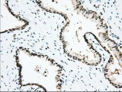 Immunohistochemistry: Isopeptidase T/USP5 Antibody (OTI2E3) - Azide and BSA Free [NBP2-71355] - Staining of paraffin-embedded Carcinoma of Human prostate tissue using anti-USP5 mouse monoclonal antibody.