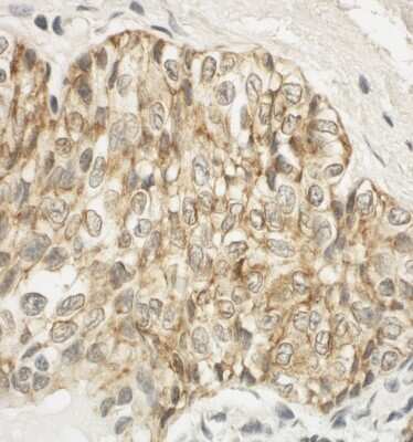 Immunohistochemistry-Paraffin: JAM-A Antibody [NBP1-49908] - Human prostate carcinoma. Antibody: Affinity purified rabbit anti-JAM-A used at a dilution of 1:200 (1ug/ml). Detection: DAB