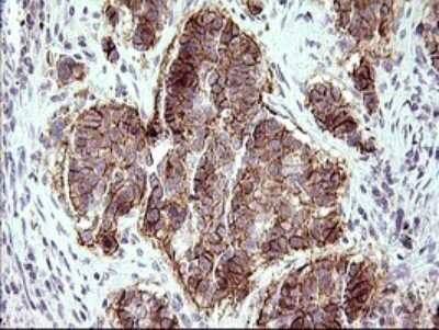 Immunohistochemistry: JAM-A Antibody (OTI3H3) - Azide and BSA Free [NBP2-71876] - Analysis of Carcinoma of Human lung tissue.(Heat-induced epitope retrieval by 10mM citric buffer, pH6.0, 120C for 3min)
