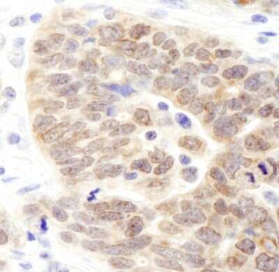 Immunohistochemistry: JMJD1B Antibody [NB110-38879] - Sample: FFPE section of human ovarian carcinoma. Antibody: Affinity purified rabbit anti- JMJD1B used at a dilution of 1:200 (1ug/ml). Detection: DAB