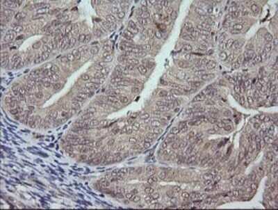 Immunohistochemistry: JNK2 Antibody (OTI1A1) - Azide and BSA Free [NBP2-71259] - Analysis of Adenocarcinoma of Human endometrium tissue. (Heat-induced epitope retrieval by 10mM citric buffer, pH6.0, 120C for 3min)