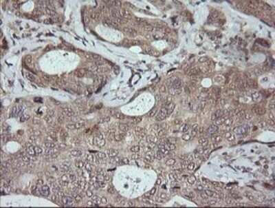 Immunohistochemistry: JNK2 Antibody (OTI1A1) [NBP2-45815] - Analysis of Adenocarcinoma of Human breast tissue. (Heat-induced epitope retrieval by 10mM citric buffer, pH6.0, 120C for 3min)