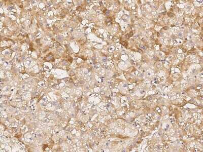 Immunohistochemistry: Jade-1/PHF17 Antibody [NBP2-98965] - Immunochemical staining of human Jade-1/PHF17 in human hepatoma with rabbit polyclonal antibody (1:500, formalin-fixed paraffin embedded sections).