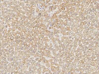 Immunohistochemistry-Paraffin: Jade-1/PHF17 Antibody [NBP2-98965] - Immunochemical staining of human Jade-1/PHF17 in human hepatoma with rabbit polyclonal antibody (1:500, formalin-fixed paraffin embedded sections).