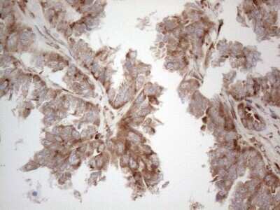 Immunohistochemistry: Jagged 1 Antibody (OTI3A10) - Azide and BSA Free [NBP2-70115] - Analysis of Adenocarcinoma of Human ovary tissue. (Heat-induced epitope retrieval by 1mM EDTA in 10mM Tris buffer (pH8.5) at 120C for 3 min)